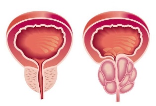 prostatitis