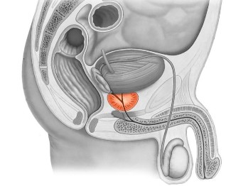 Vospalenie prostate