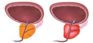 prostatitis in men